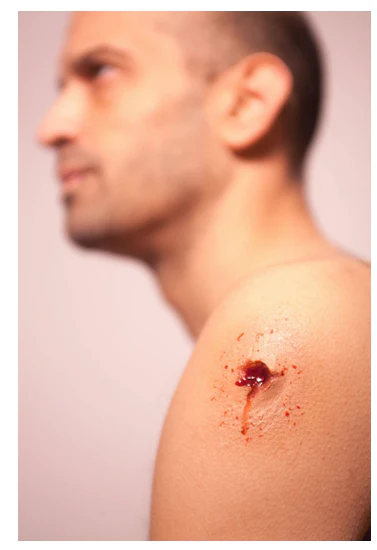 Gunshot wounds - G1/G2/G3 Silicone Prosthetic - Image 4