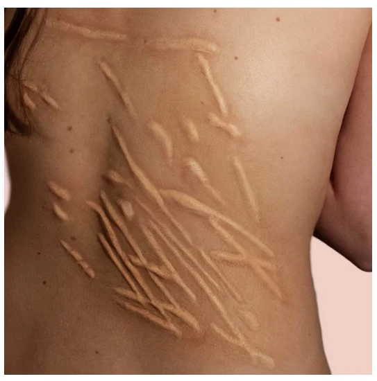 Whip scar - T2 Silicone Prosthetic - Image 2
